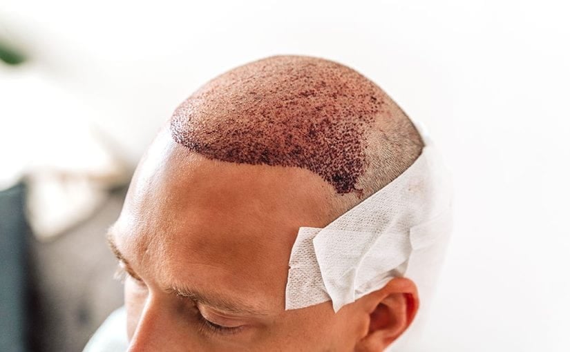 Does Hair Transplant Permanently Solve Baldness?